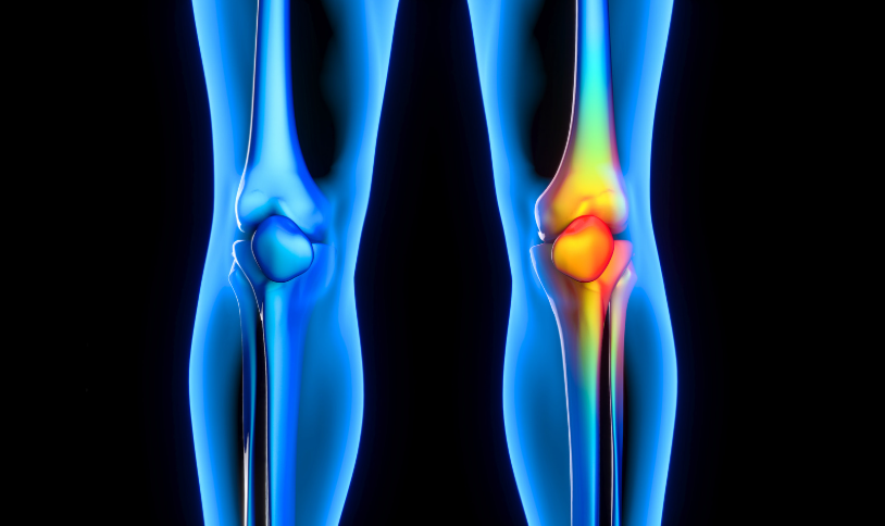 Knee Arthritis Treatment