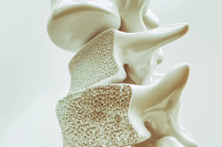Osteoporosis bone model