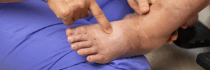 Leg Swelling and Pitting Edema in the Foot and Ankle