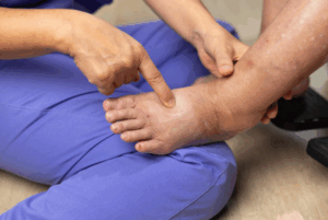 Leg Swelling and Pitting Edema in the Foot and Ankle