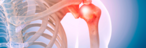 Shoulder Labrum Tears and the Mayo Shear Test