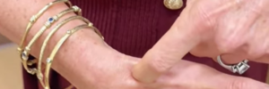 Anatomical Snuffbox location from Dr. Stacie Grossfeld