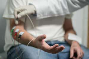 EMG nerve conduction study for cubital tunnel syndrome