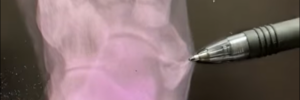 Accessory Navicular Bone on Xray