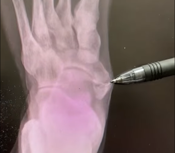 Accessory Navicular Bone on Xray