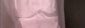 bone on bone arthritis shown on an xray
