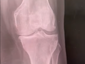 bone on bone arthritis shown on an xray