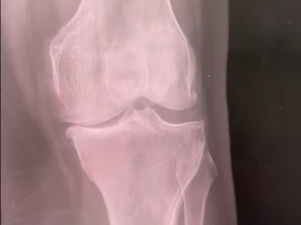 bone on bone arthritis shown on an xray