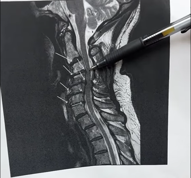 Cervical Spine MRI Abnormalities that Cause Neck Pain